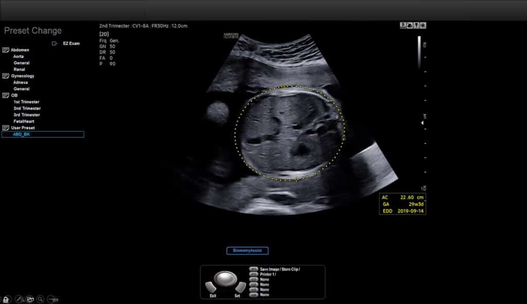 image 2 Intel AI Powers Samsung Medison’s Fetal Ultrasound Smart Workflow
